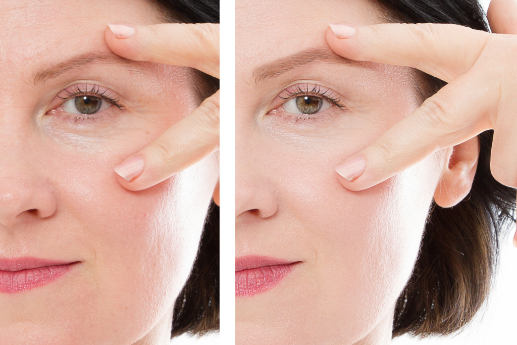 Frau mittleren Alters vor und nach der Behandlung: faltige Haut, Tränensäcke, Nasolabialfalten.